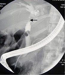 Picture taken at ERCP showing a cancerous obstruction high up in the common bile duct