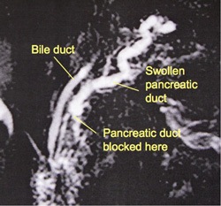 MRCP picture of the pancreatic duct