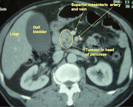 CT scan showing a tumour of the pancreatic head